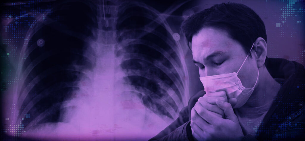 74% Pinoys Have Not Been Tested for Tuberculosis